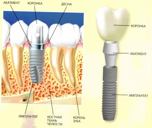 Имплантация зубов